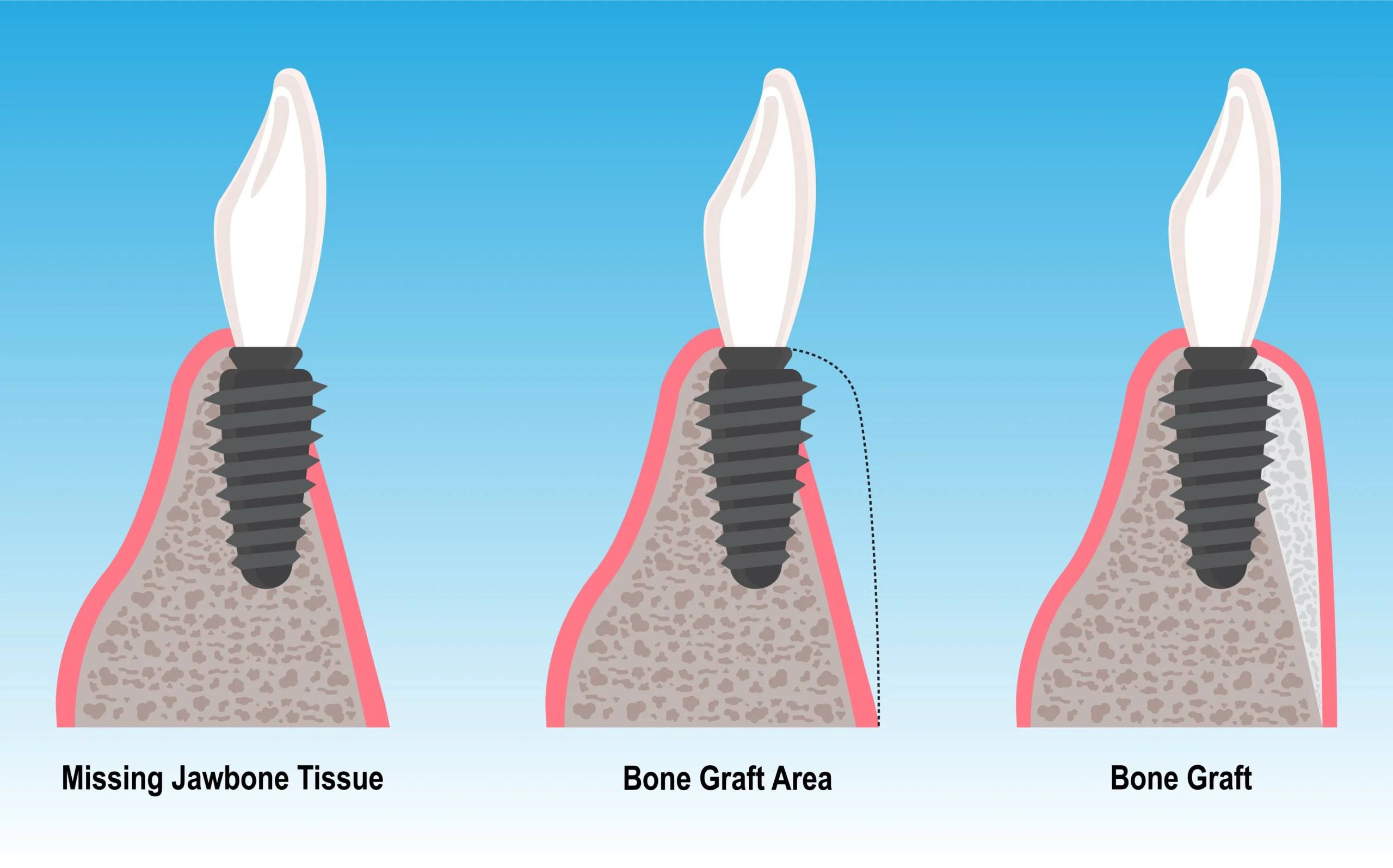 bone grafting in delta, bc