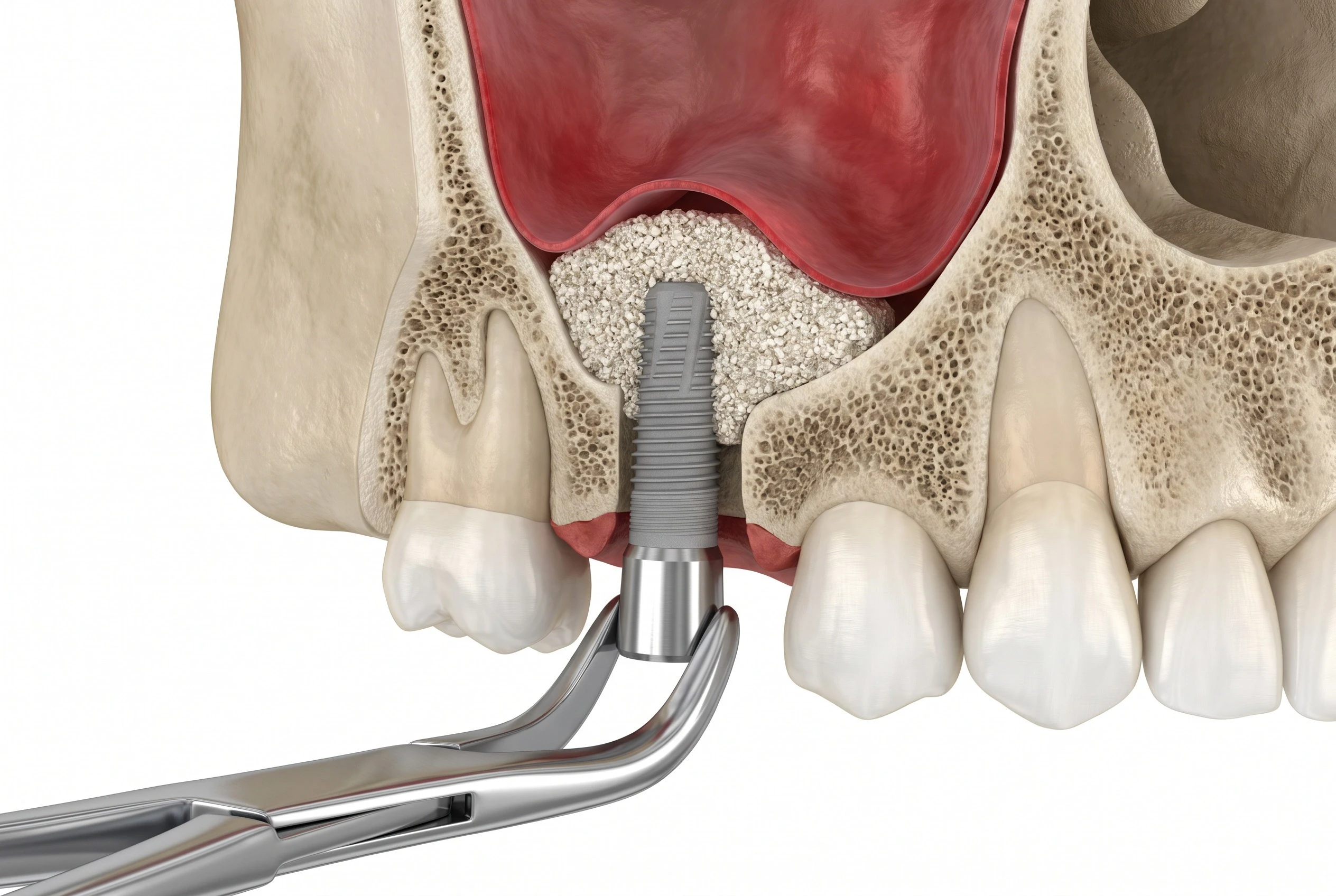 bone grafting near you