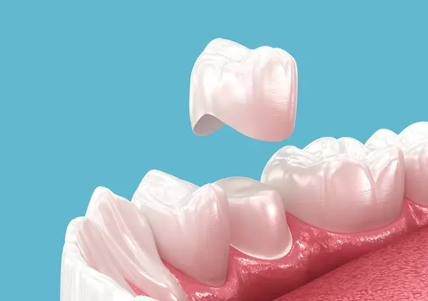 cerec same day crowns near you