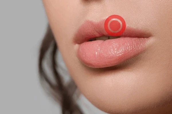 cold sore laser therapy in delta, bc