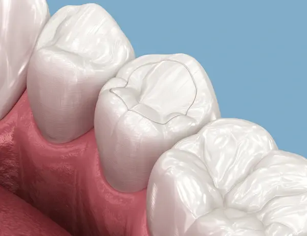 composite dental fillings in delta, bc