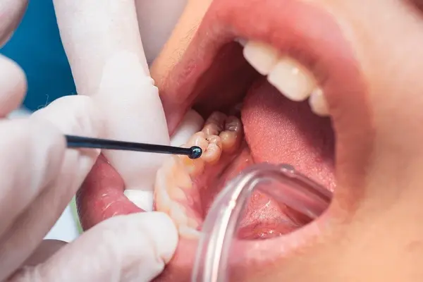 composite dental fillings near you