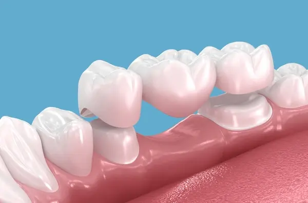 dental bridges in delta, bc