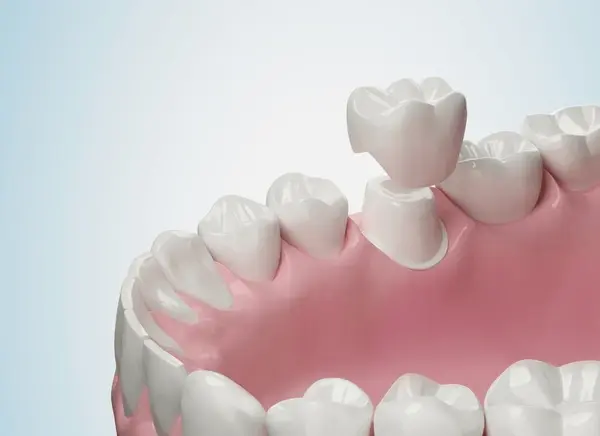 dental crowns near you