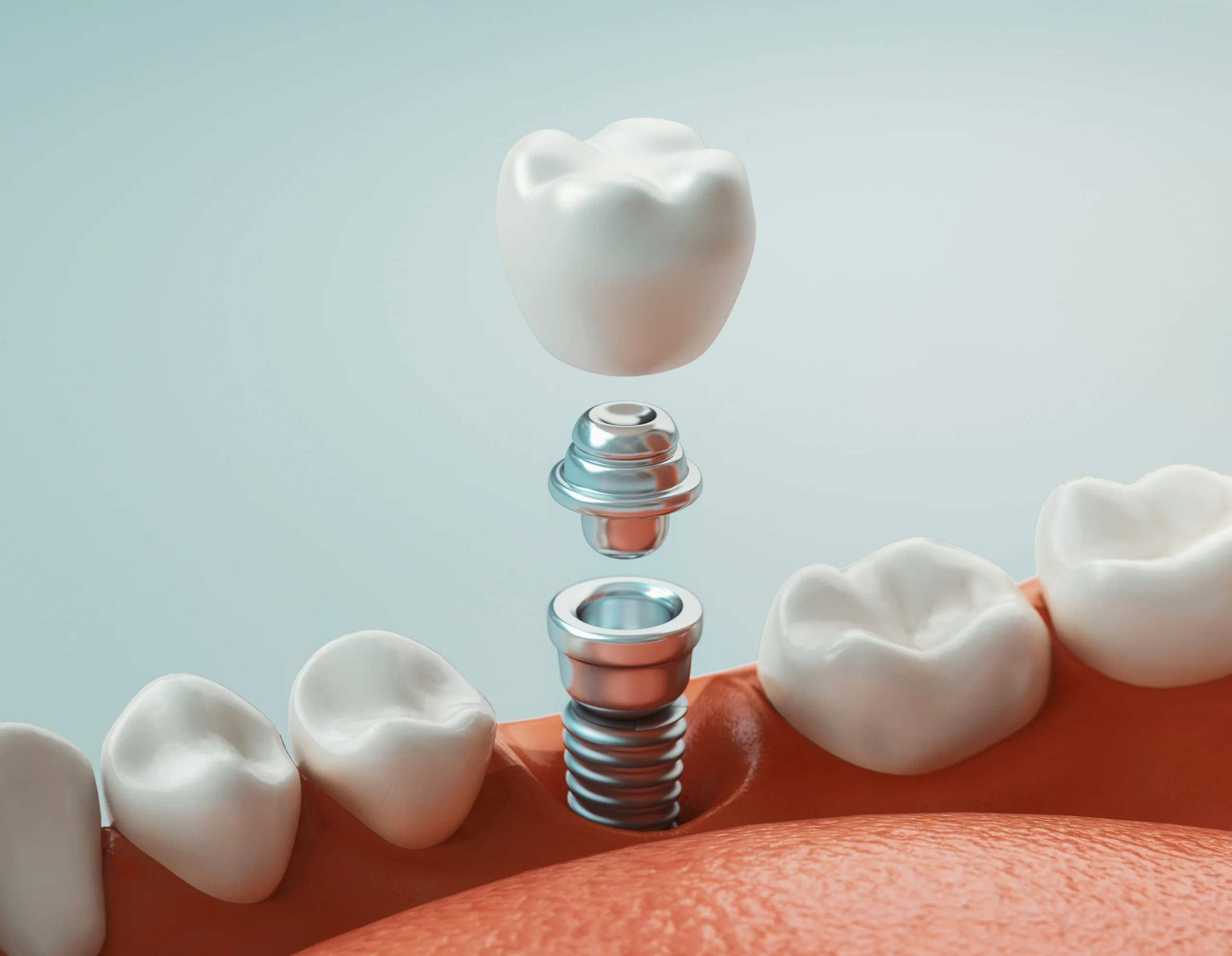 dental implants in delta, bc