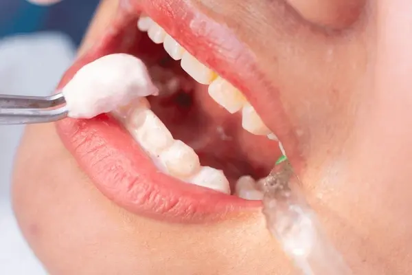 fluoride therapy in delta, bc