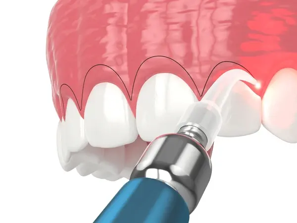 gum contouring near you