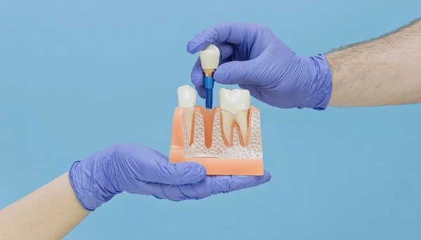implant restorations near you