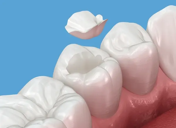 porcelain inlays onlays near you
