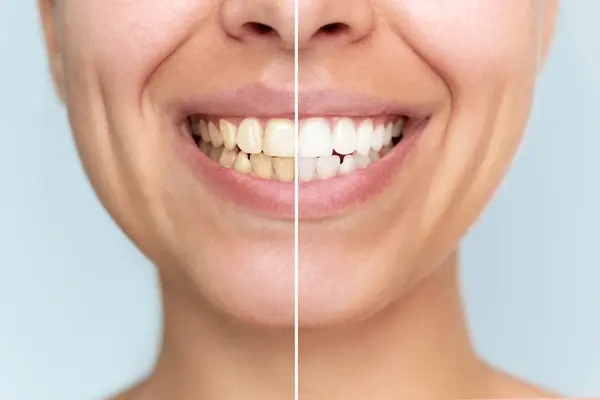 professional teeth whitening in delta, bc