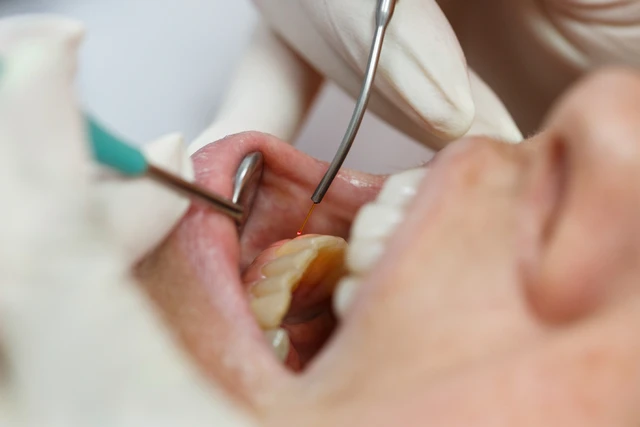 soft tissue laser dentistry in delta, bc