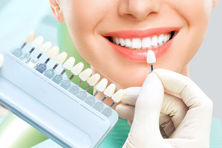 porcelain veneers for teeth restoration